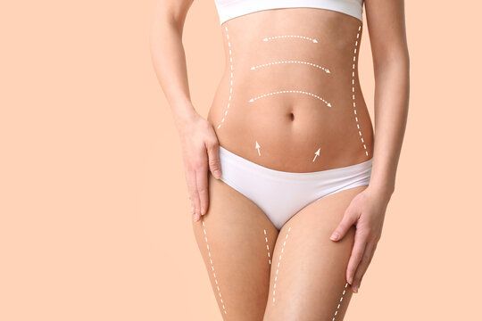 Liposuction for Women: Achieving Your Ideal Shape